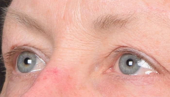 Eyelid Surgery Before & After Image