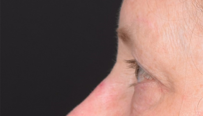 Eyelid Surgery Before & After Image