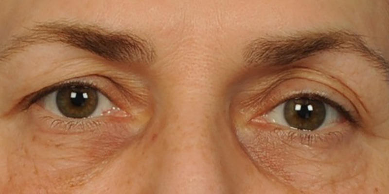 Eyelid Surgery Before & After Image