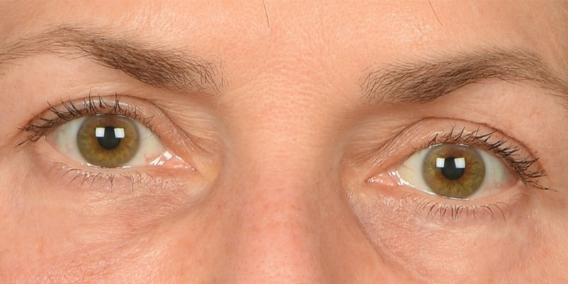 Eyelid Surgery Before & After Image