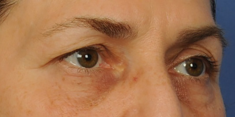 Eyelid Surgery Before & After Image