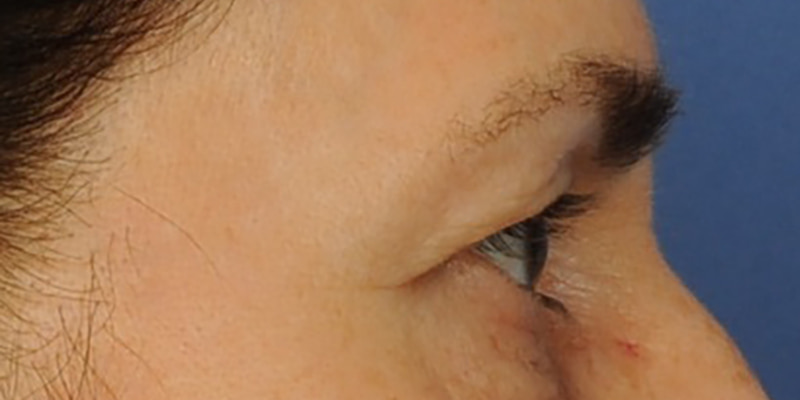 Eyelid Surgery Before & After Image