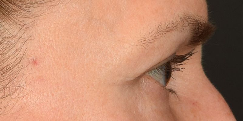 Eyelid Surgery Before & After Image