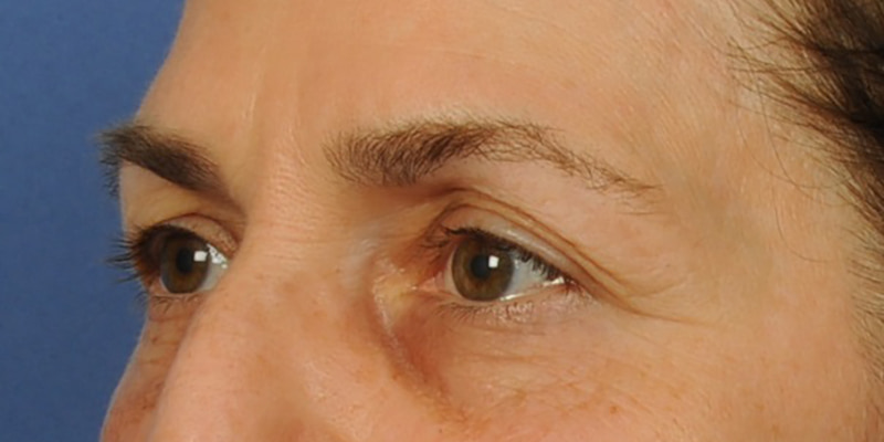 Eyelid Surgery Before & After Image