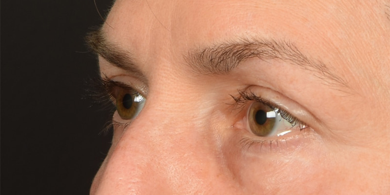 Eyelid Surgery Before & After Image