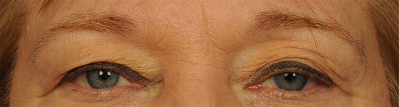 Eyelid Surgery Before & After Image