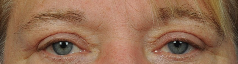 Eyelid Surgery Before & After Image