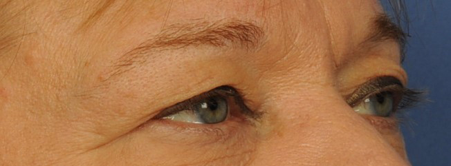 Eyelid Surgery Before & After Image