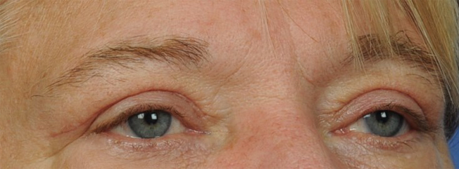 Eyelid Surgery Before & After Image