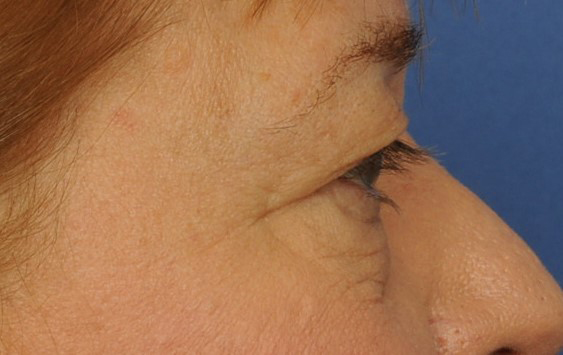 Eyelid Surgery Before & After Image