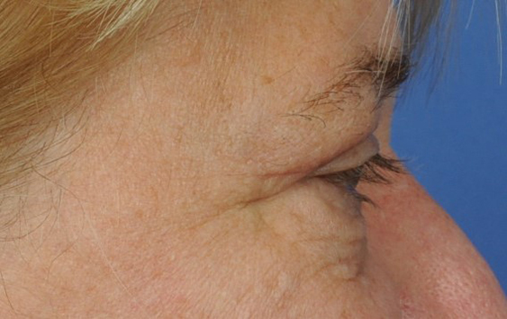 Eyelid Surgery Before & After Image