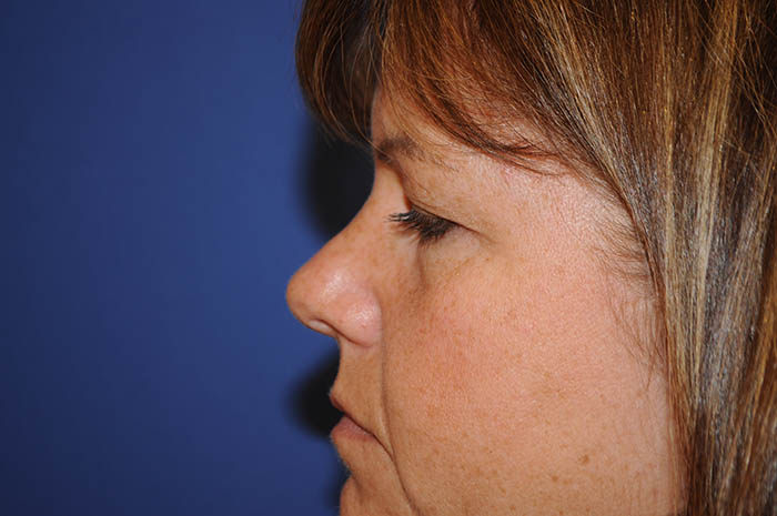 Eyelid Surgery Before & After Image