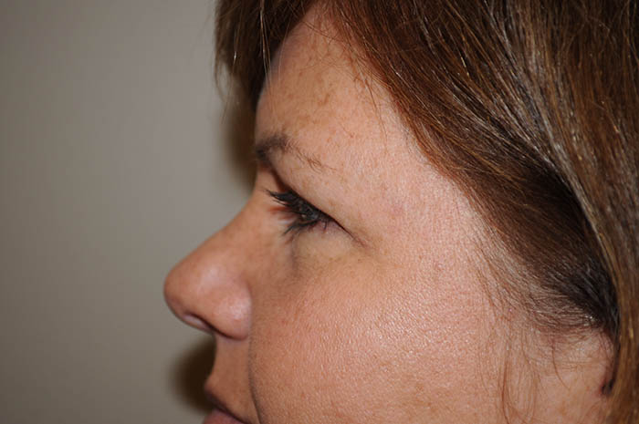 Eyelid Surgery Before & After Image