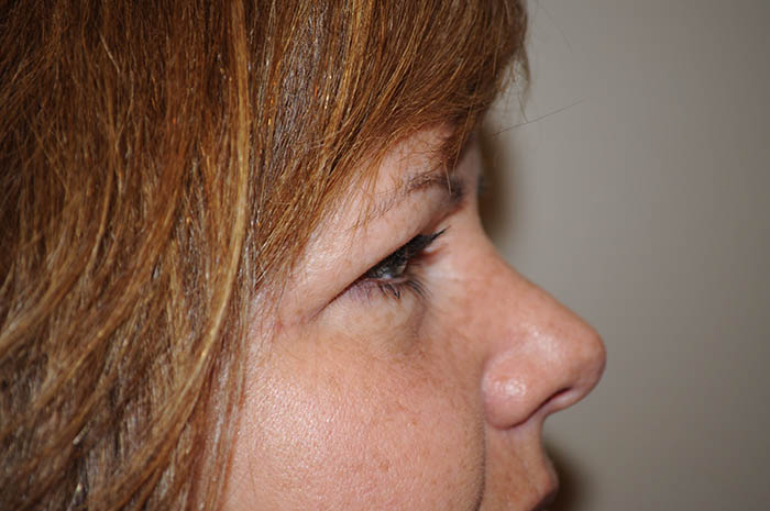 Eyelid Surgery Before & After Image