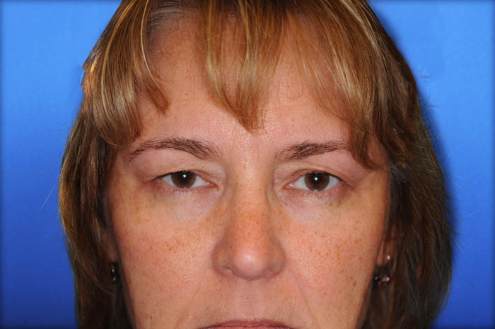 Eyelid Surgery Before & After Image