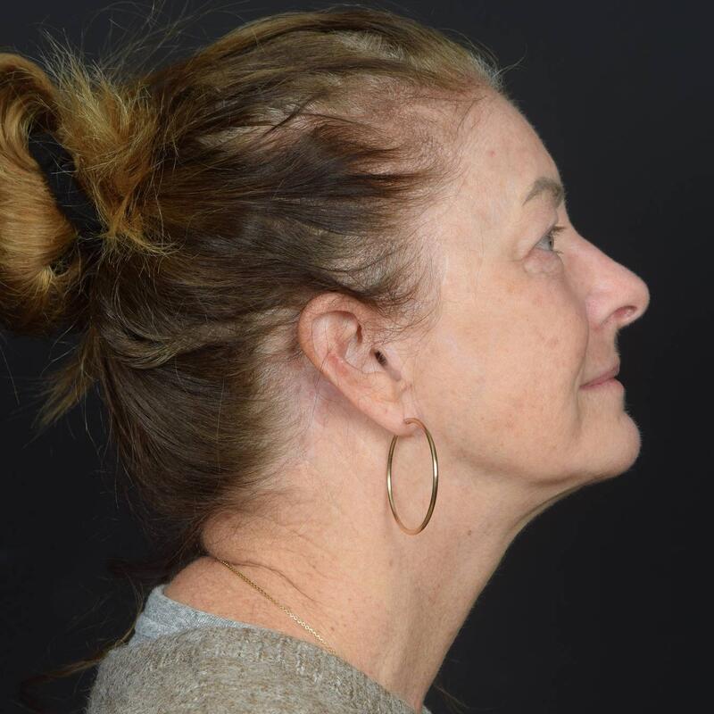 Neck Lift Before & After Image