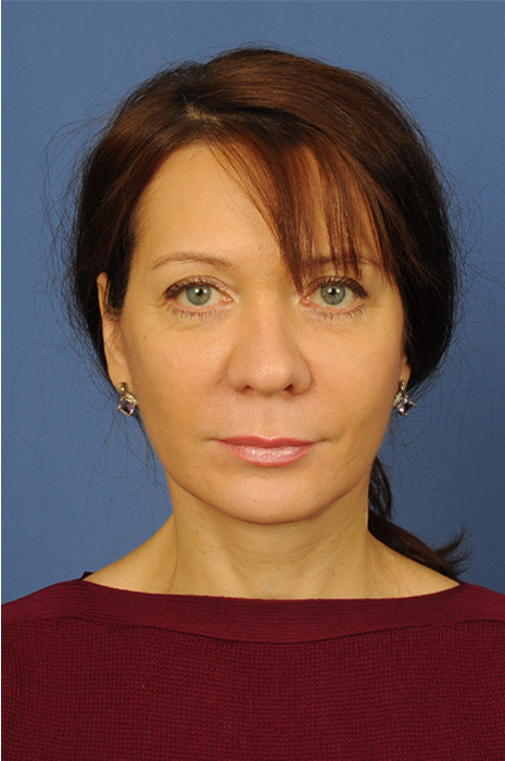 Neck Lift Before & After Image