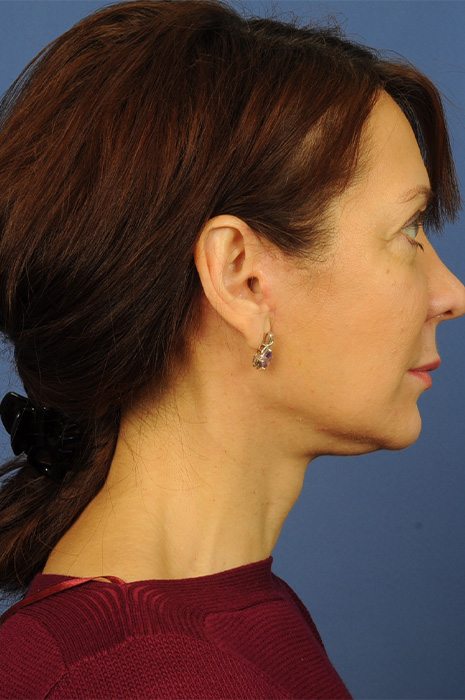 Neck Lift Before & After Image