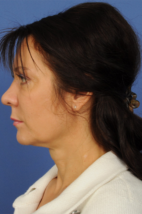 Neck Lift Before & After Image