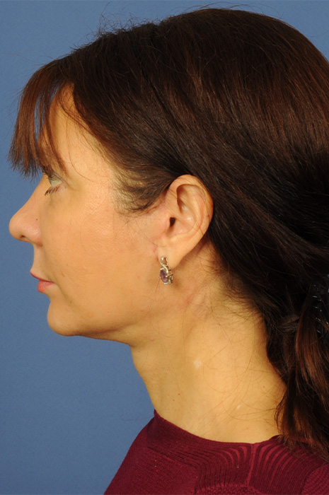 Neck Lift Before & After Image