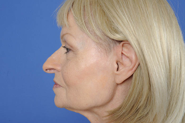 Neck Lift Before & After Image