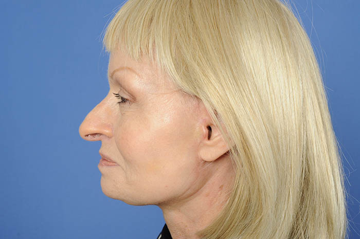 Neck Lift Before & After Image