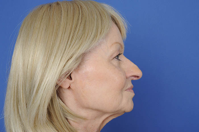 Neck Lift Before & After Image