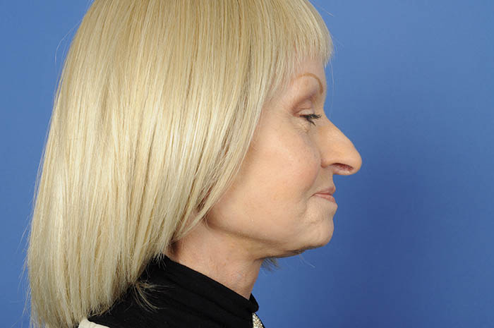 Neck Lift Before & After Image