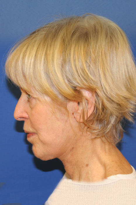 Neck Lift Before & After Image