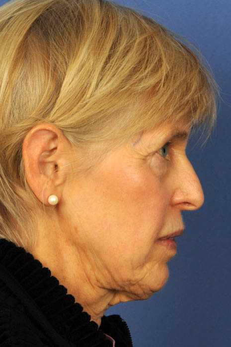 Neck Lift Before & After Image