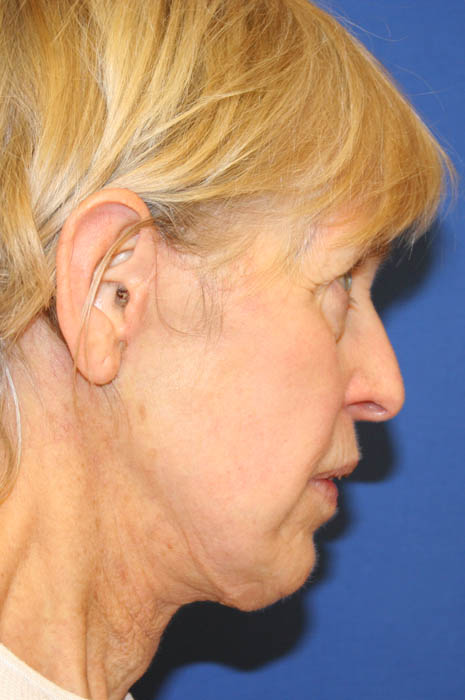 Neck Lift Before & After Image