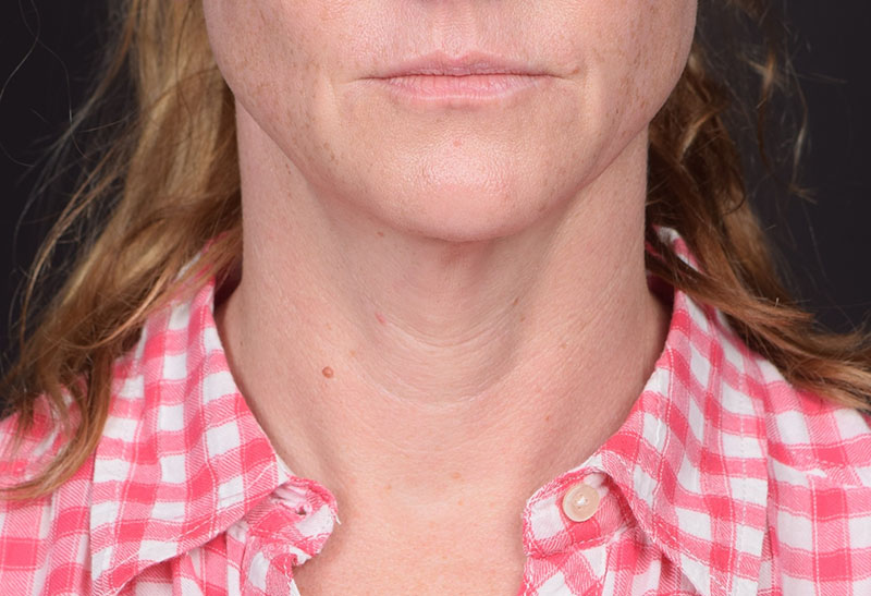 Neck Lift Before & After Image