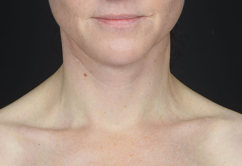 Neck Lift Before & After Image