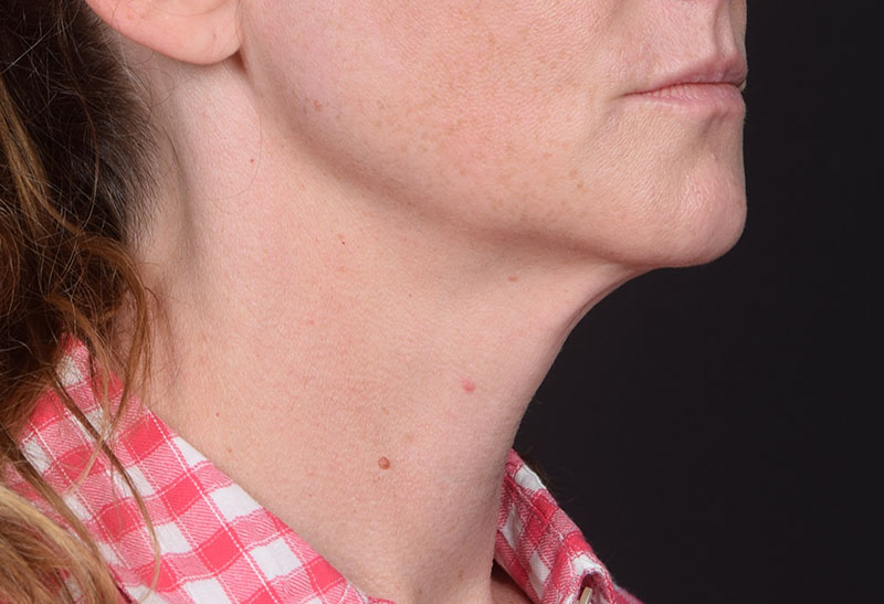 Neck Lift Before & After Image