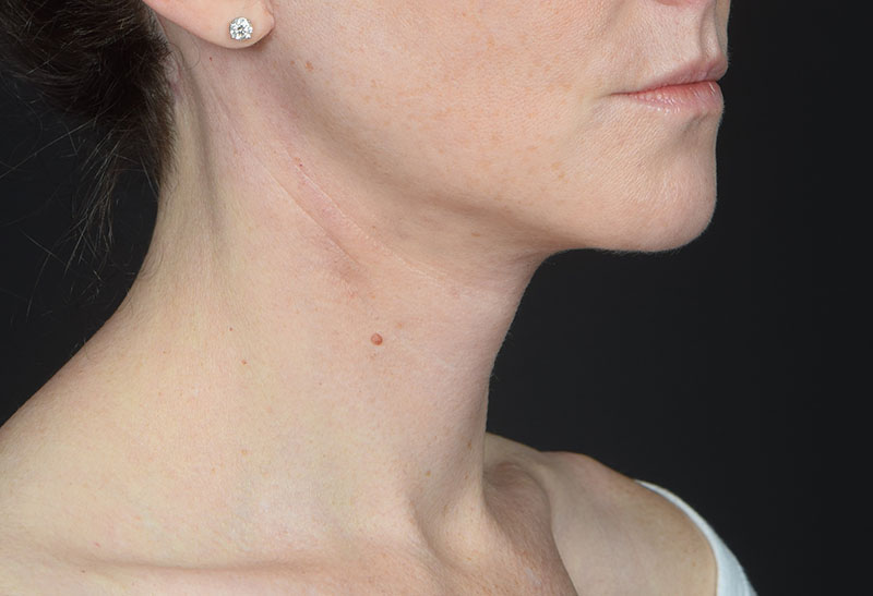 Neck Lift Before & After Image