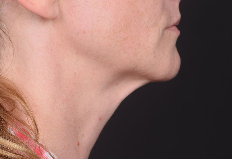 Neck Lift Before & After Image