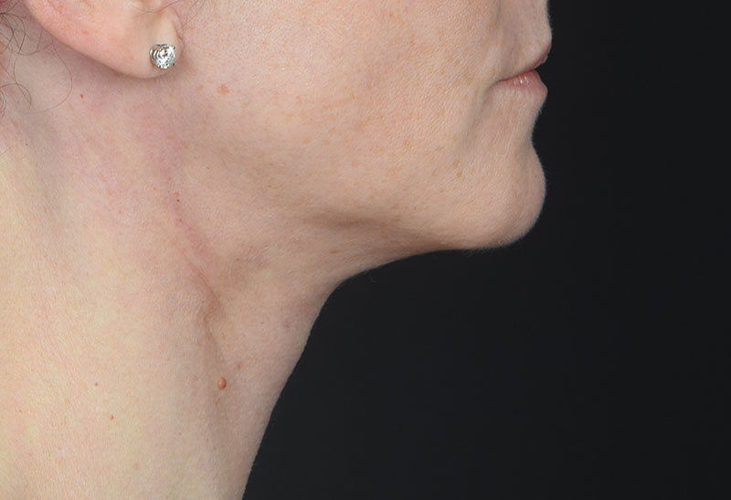 Neck Lift Before & After Image