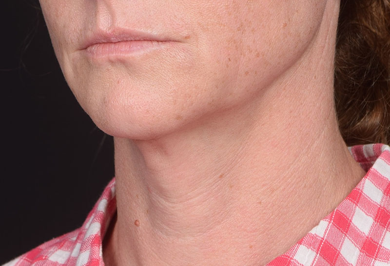 Neck Lift Before & After Image