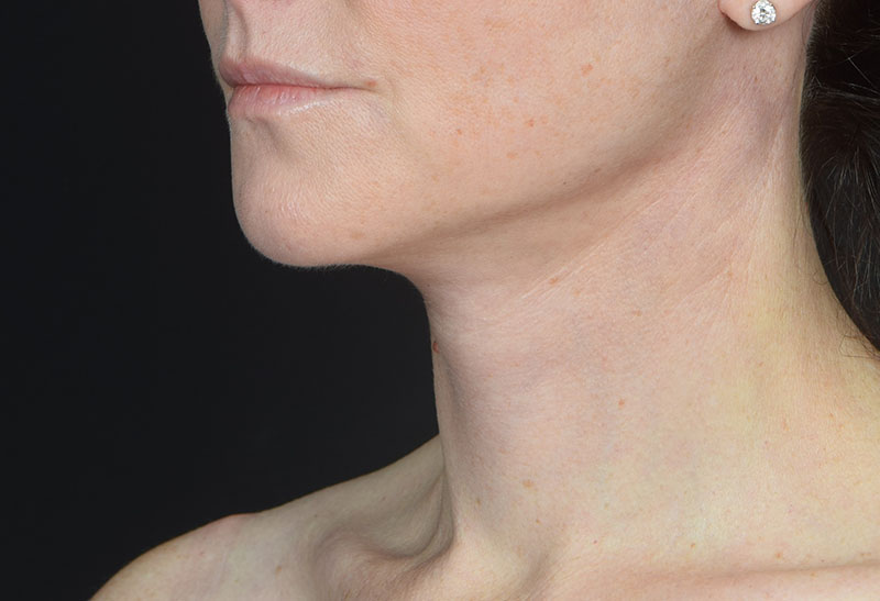 Neck Lift Before & After Image