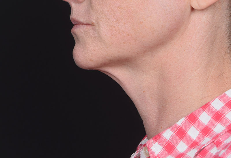 Neck Lift Before & After Image