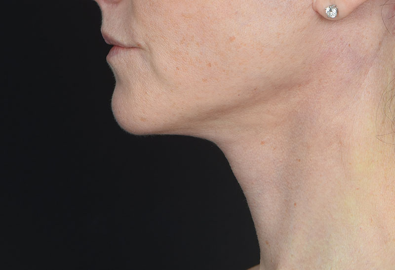 Neck Lift Before & After Image